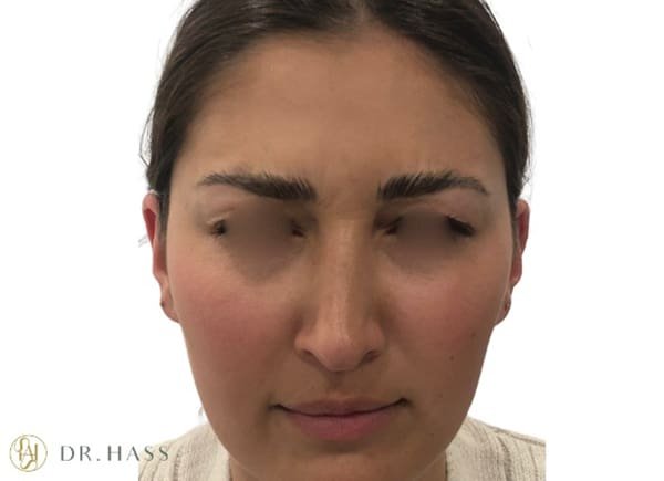 Anti Wrinkle Injections