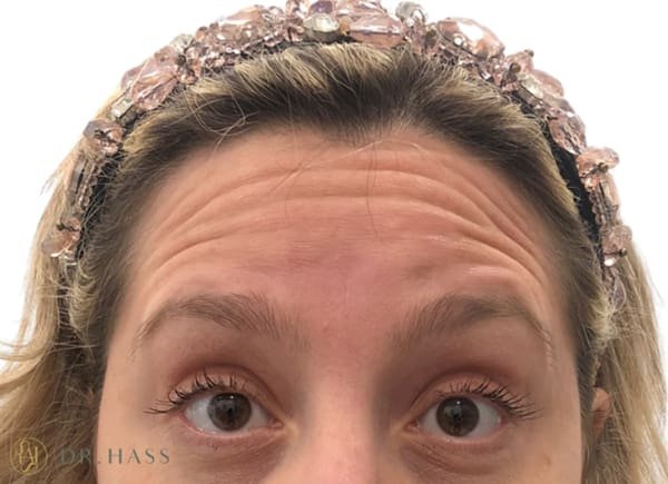 Anti Wrinkle Injections