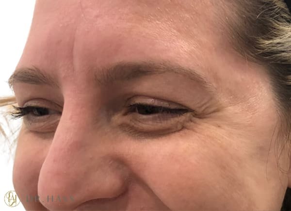 Anti Wrinkle Injections