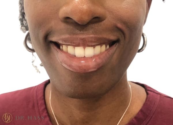 Gummy Smile