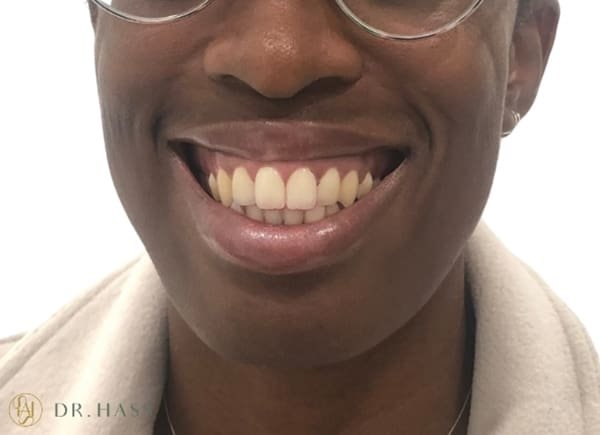 Gummy Smile