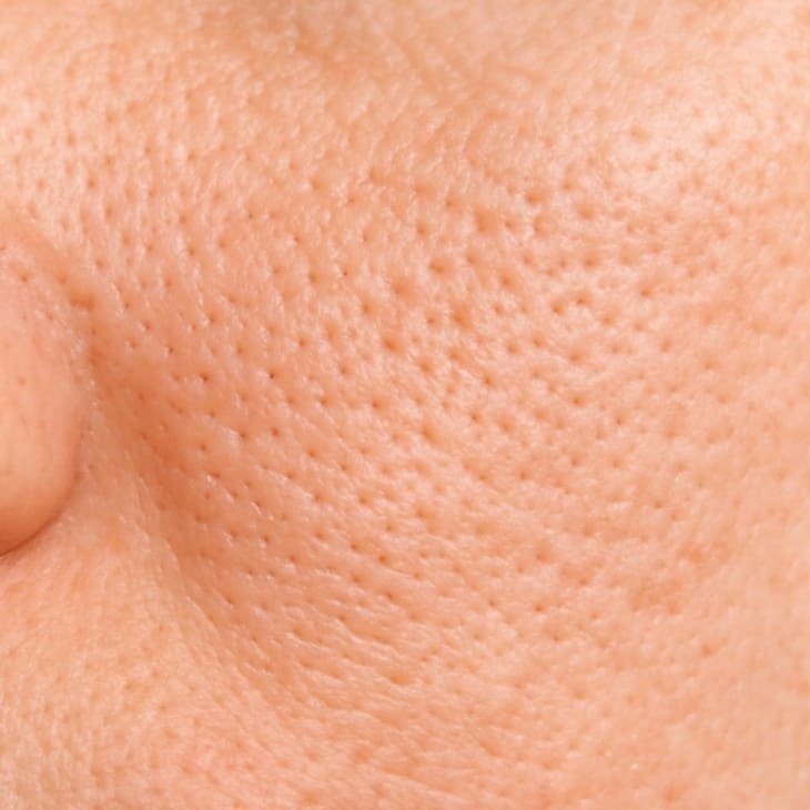 enlarged-pores