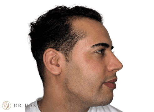 Jawline Filler After - Dr Hass Clinic