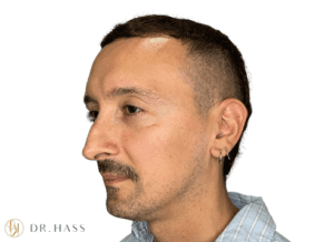 Jawline Filler Before 2 - Dr Hass Clinic