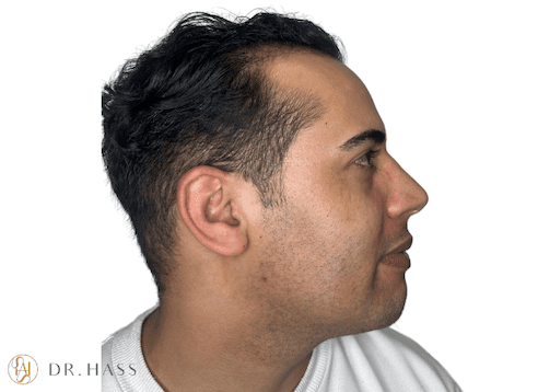 Jawline Filler Before - Dr Hass Clinic