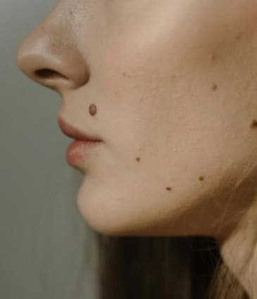 Chin Filler London - Precise Chin Augmentation Planning