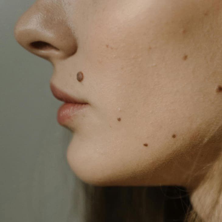Chin Filler London - Precise Chin Augmentation Planning