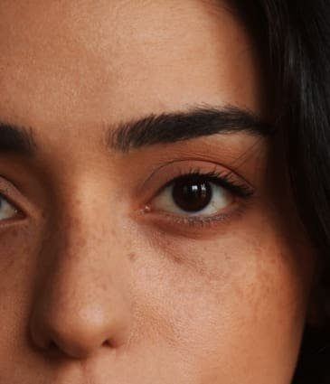 Eye Bags