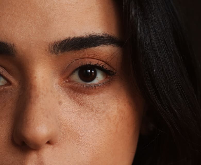 Eye Bags