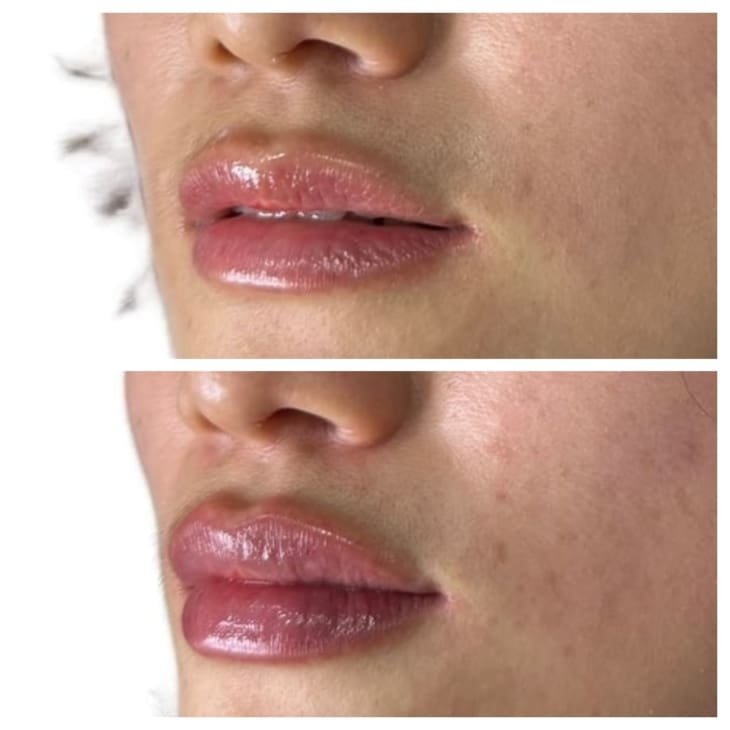 Lip Filler Before and After
