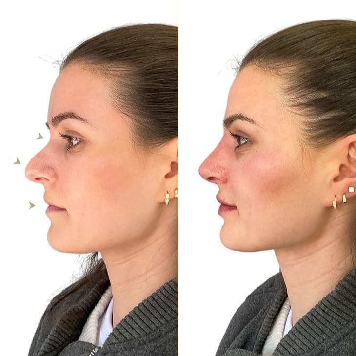 Nose Filler Before and After - Dr Hass Clinic