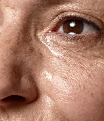 age-spots-condition