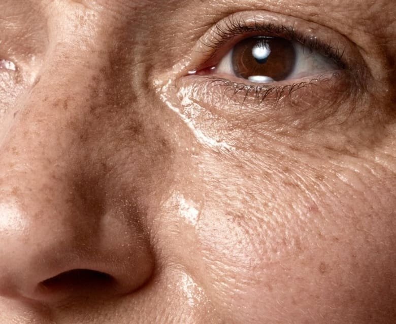 age-spots-condition