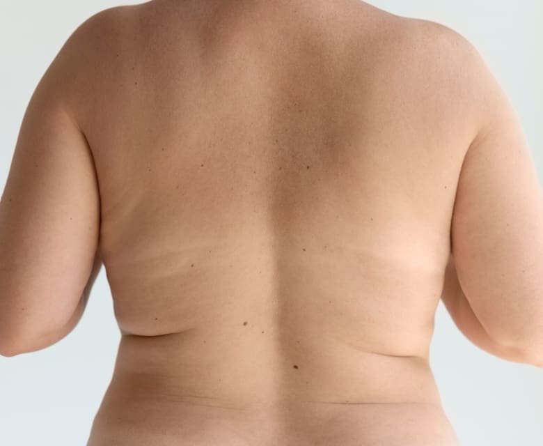 Excess Fat: Causes, Prevention and Treatments