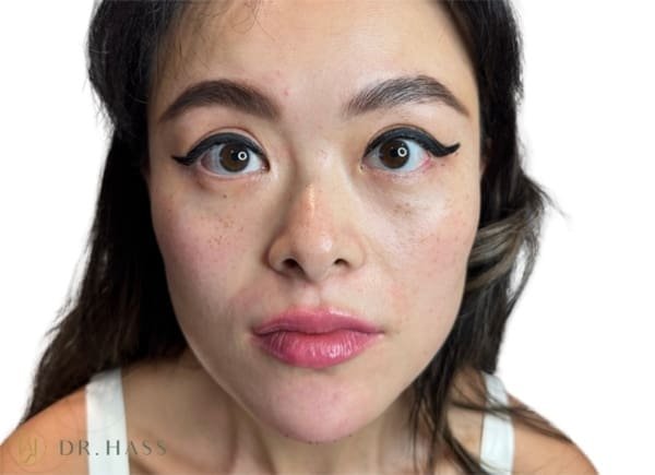 After Masseter Botox