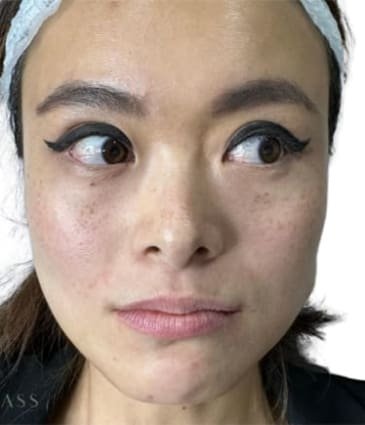 Before Masseter Botox