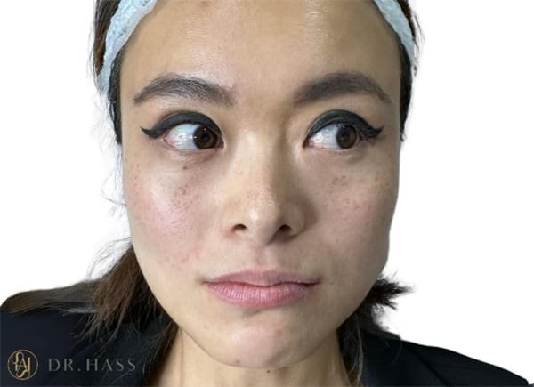 Before Masseter Botox