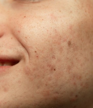 Hyperpigmentation Condition | Causes, Prevention and Treatments