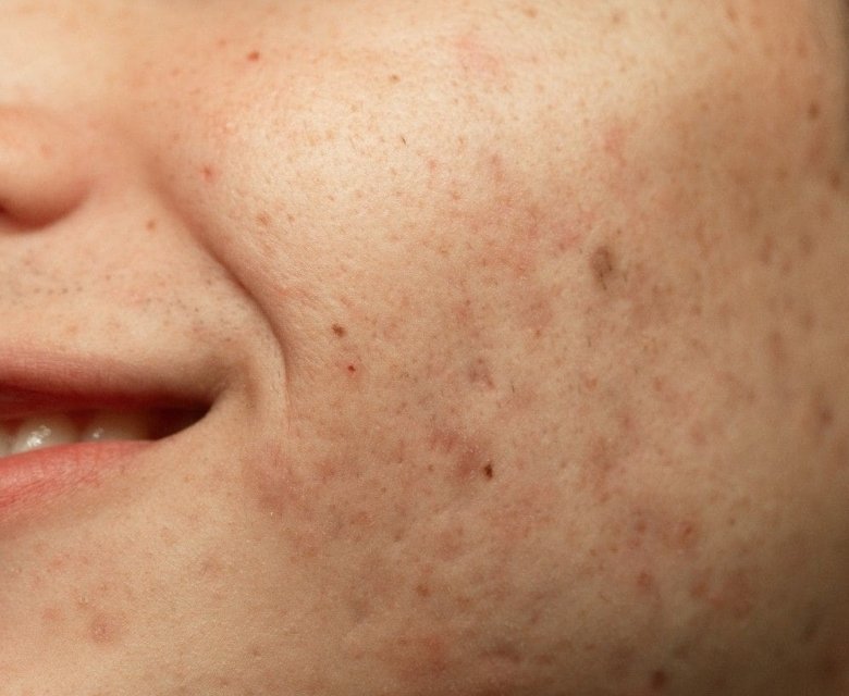 Hyperpigmentation Condition | Causes, Prevention and Treatments