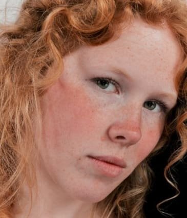 uneven-skin-tone