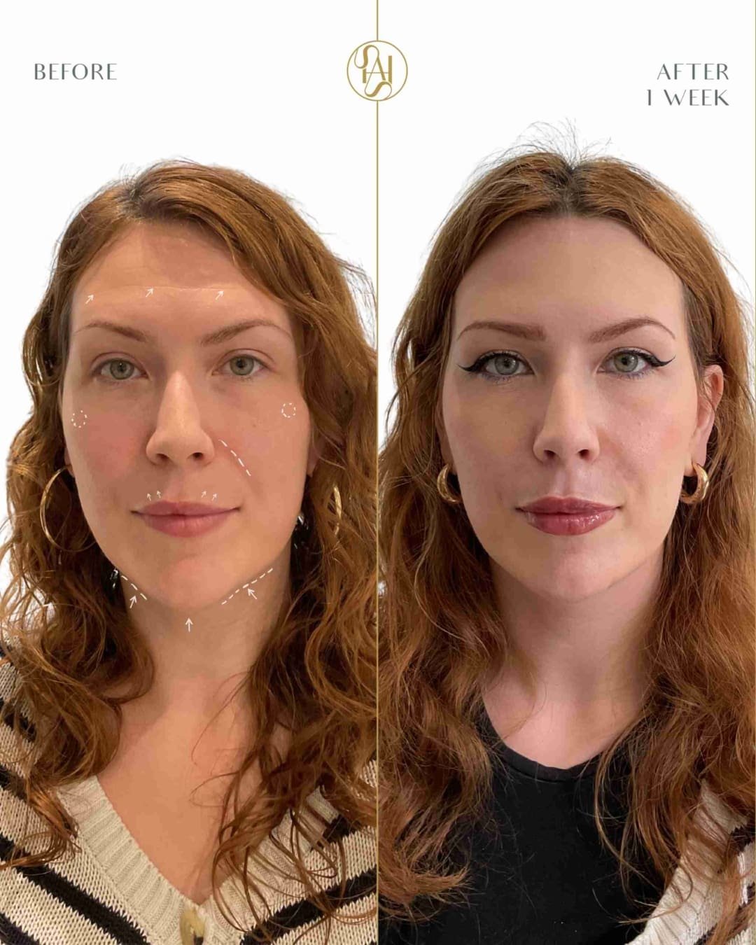 Full Face Rejuvenation Before and After Results - Dr Hass Clinic London