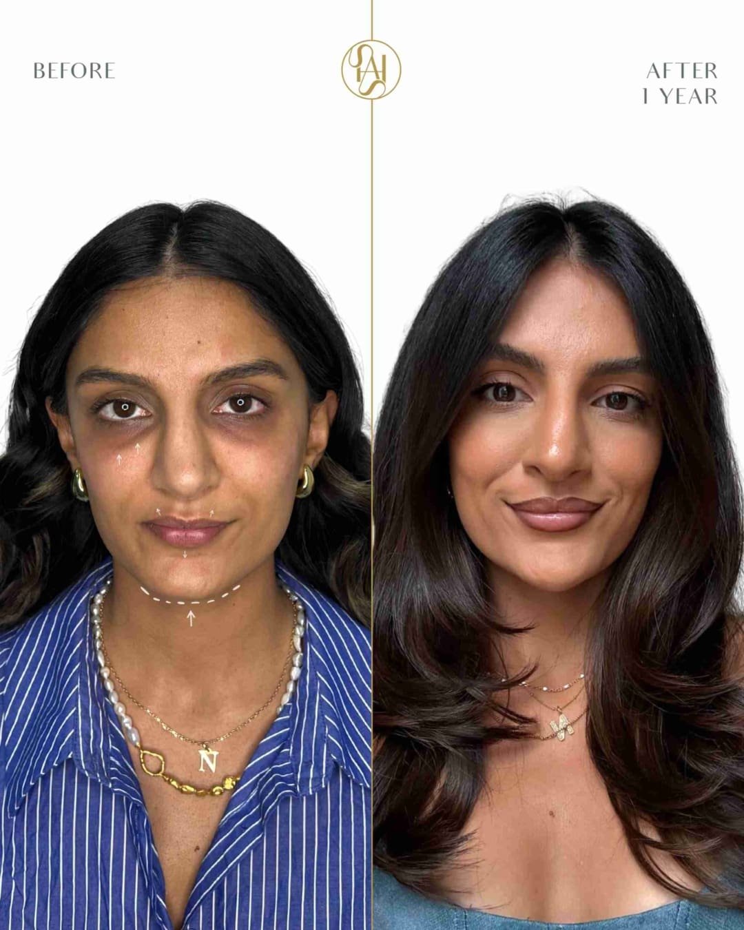 Full Face Rejuvenation Before and After Results - Dr Hass Clinic London