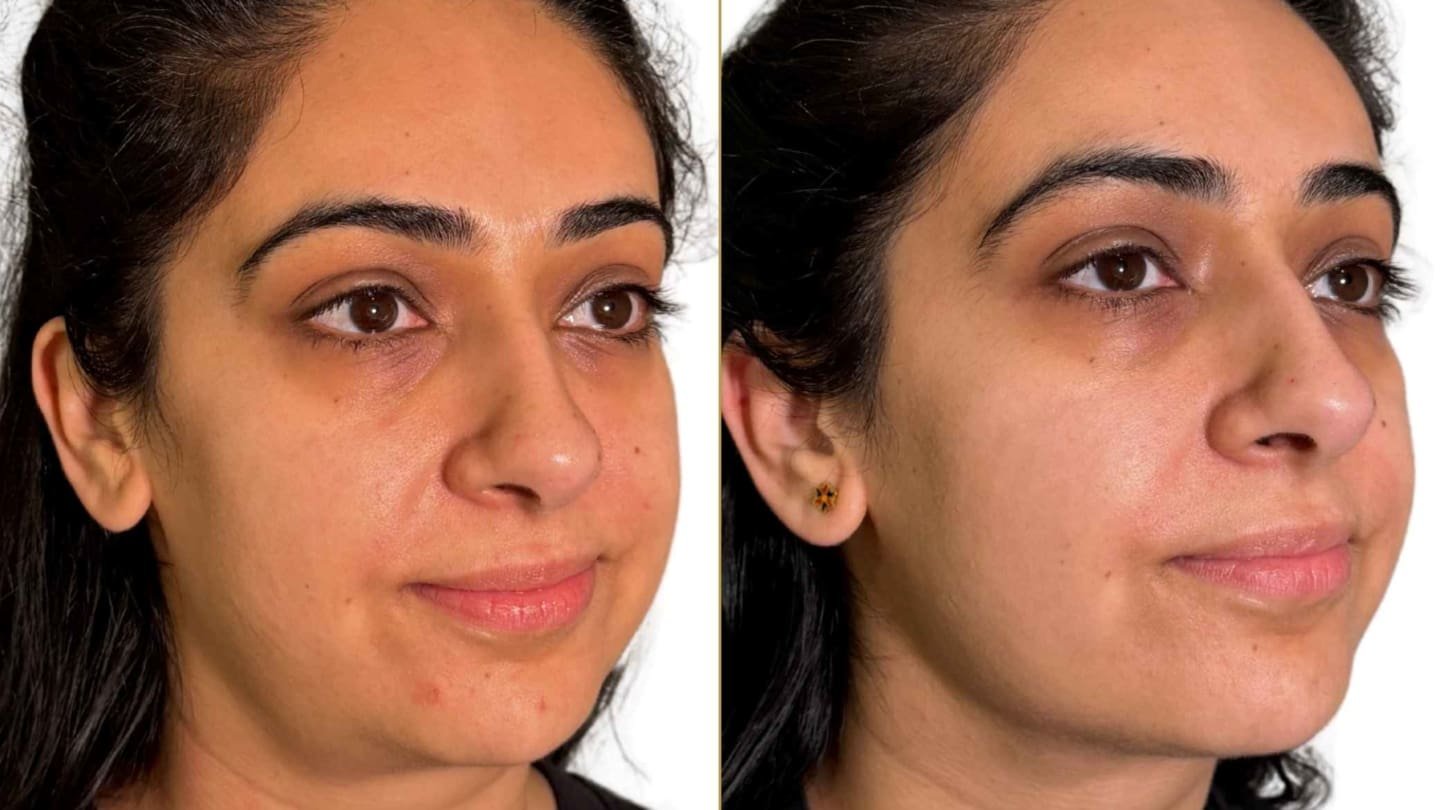 Endolift Before and After Result for Double Chin and Jawline Definition - Dr Hass Clinic in London