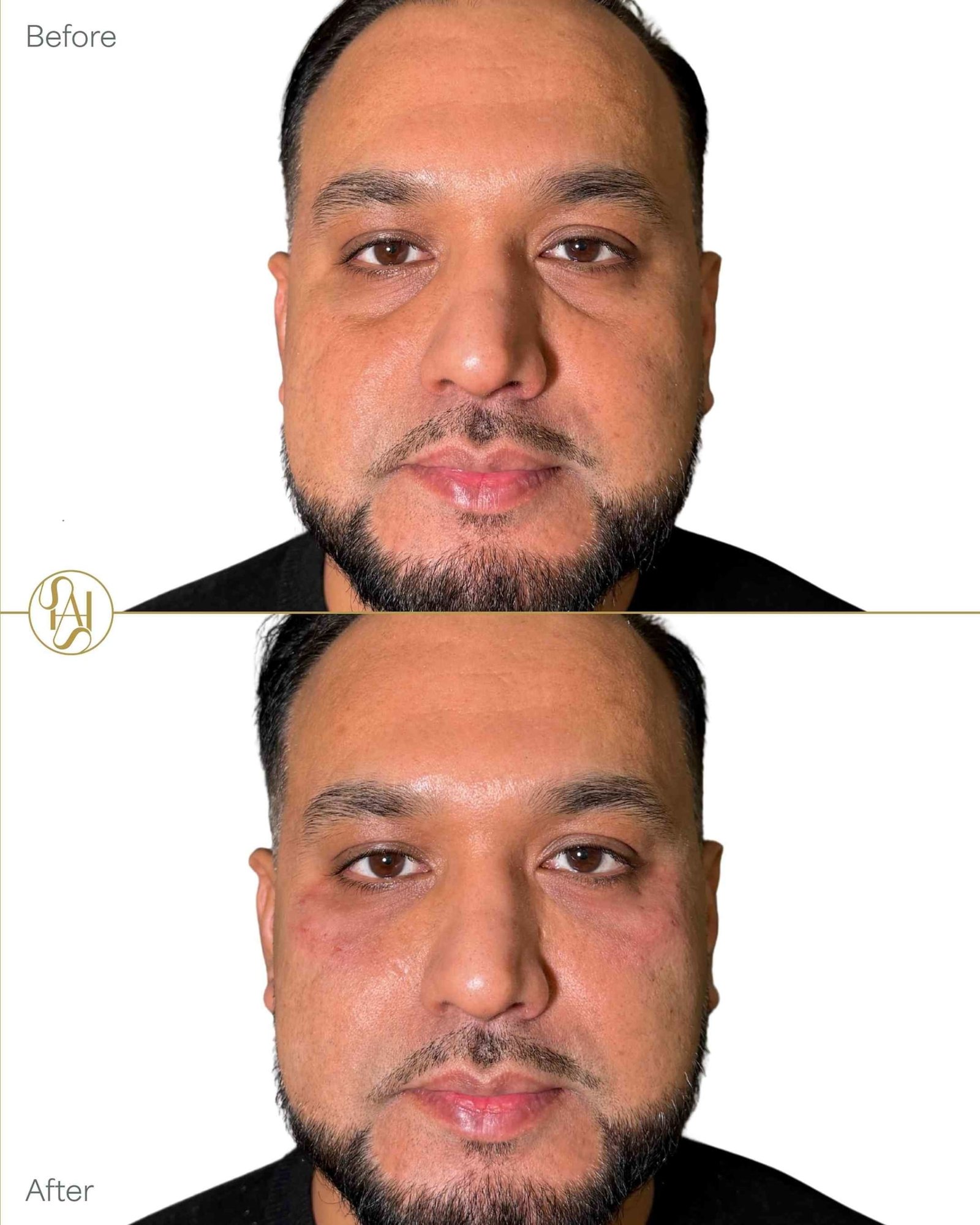 Tear Trough Filler on Male Patient for Eye Bags Before and After Results - Dr Hass Clinic in London