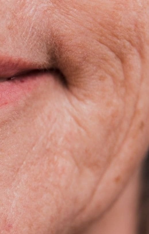 Marionette Filler - Dr Hass Clinic