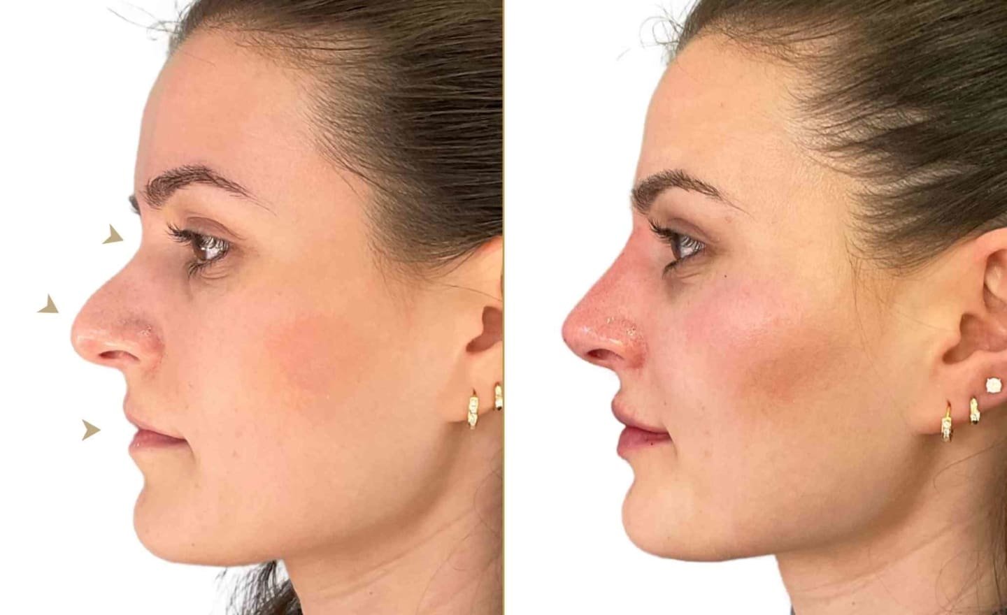 Nose Filler on Female Patient Before and After Results - Dr Hass Clinic London