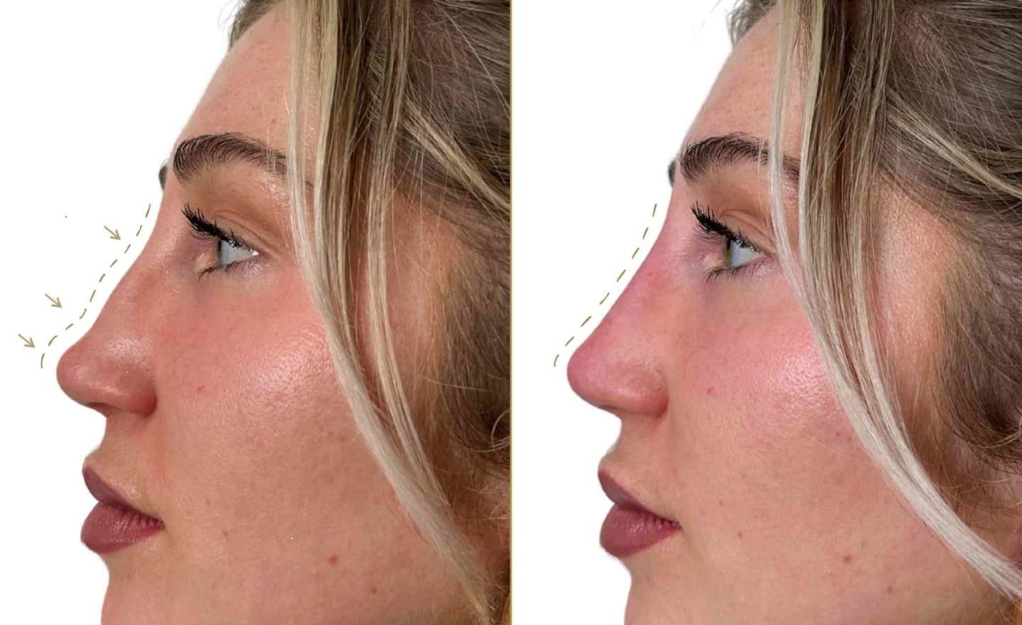 Nose Filler on Female Patient Before and After Results - Dr Hass Clinic London