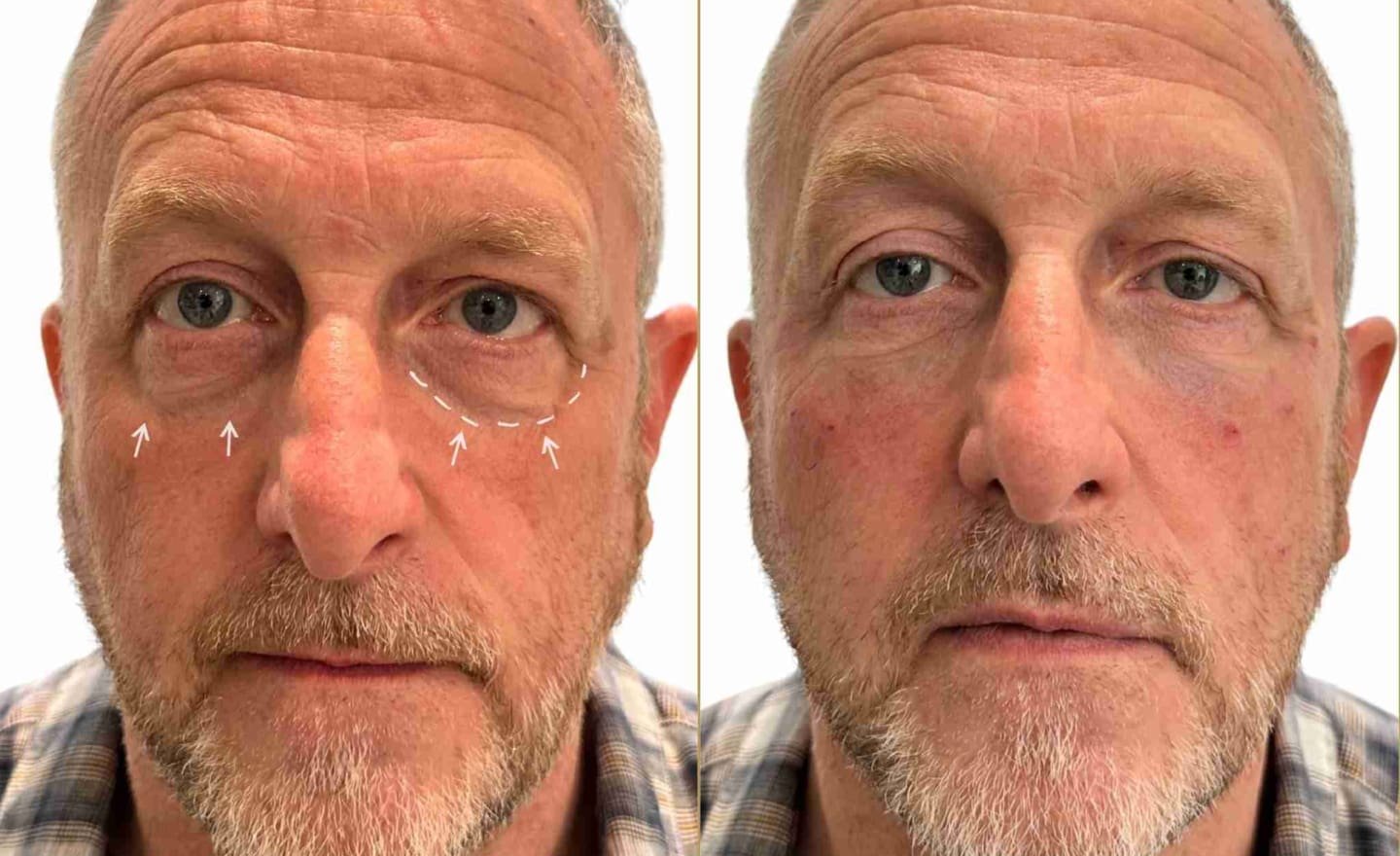 Tear Trough Filler on Male Patient for Eye Bags Before and After Results - Dr Hass Clinic London