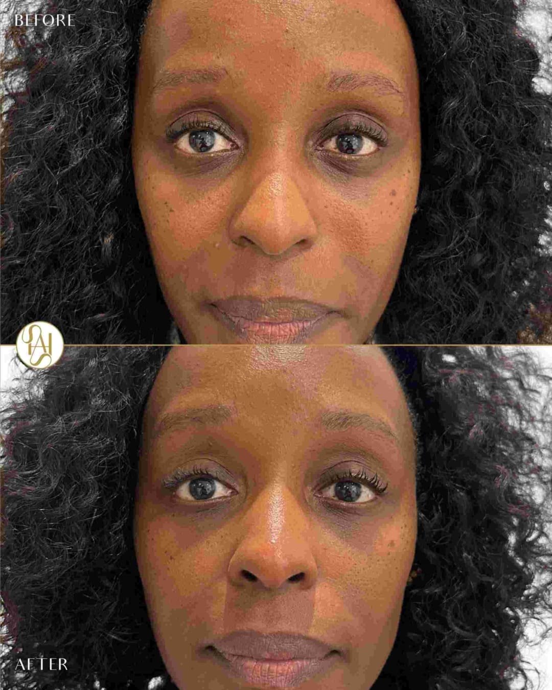 Tear Trough Filler on Female Patient Before and After Results - Dr Hass Clinic London