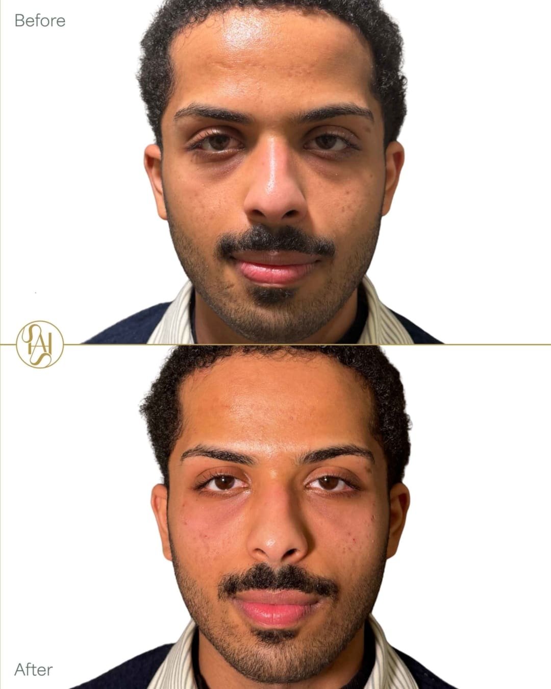 Tear Trough Filler on Male Patient Before and After Results - Dr Hass Clinic London