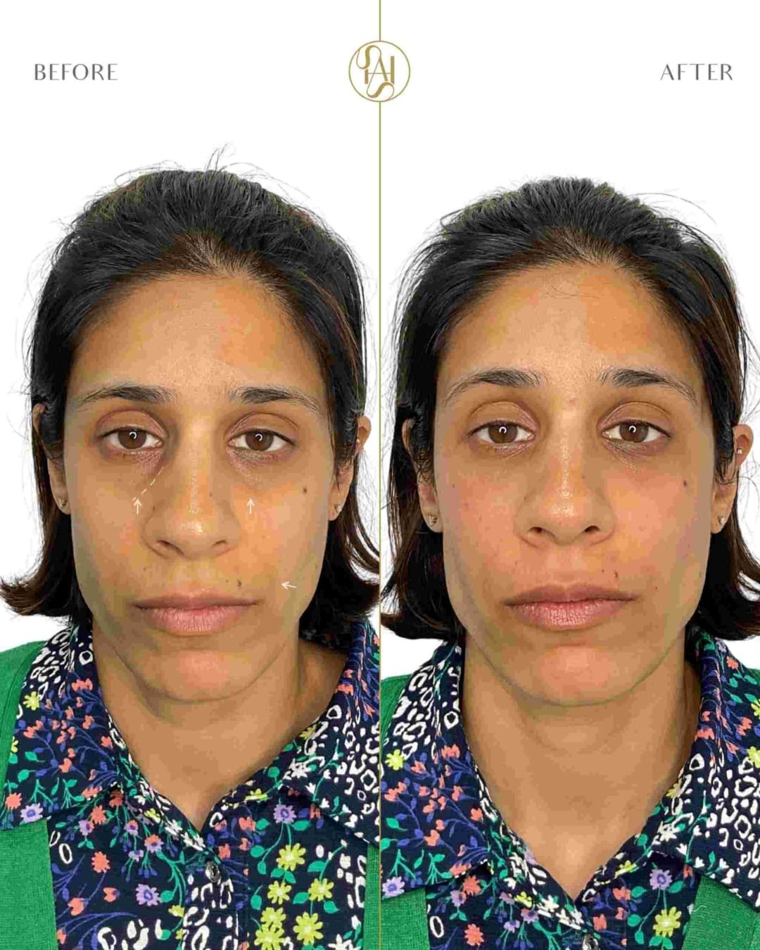 Tear Trough Filler on Female Patient for Dark Circles Before and After Results - Dr Hass Clinic London