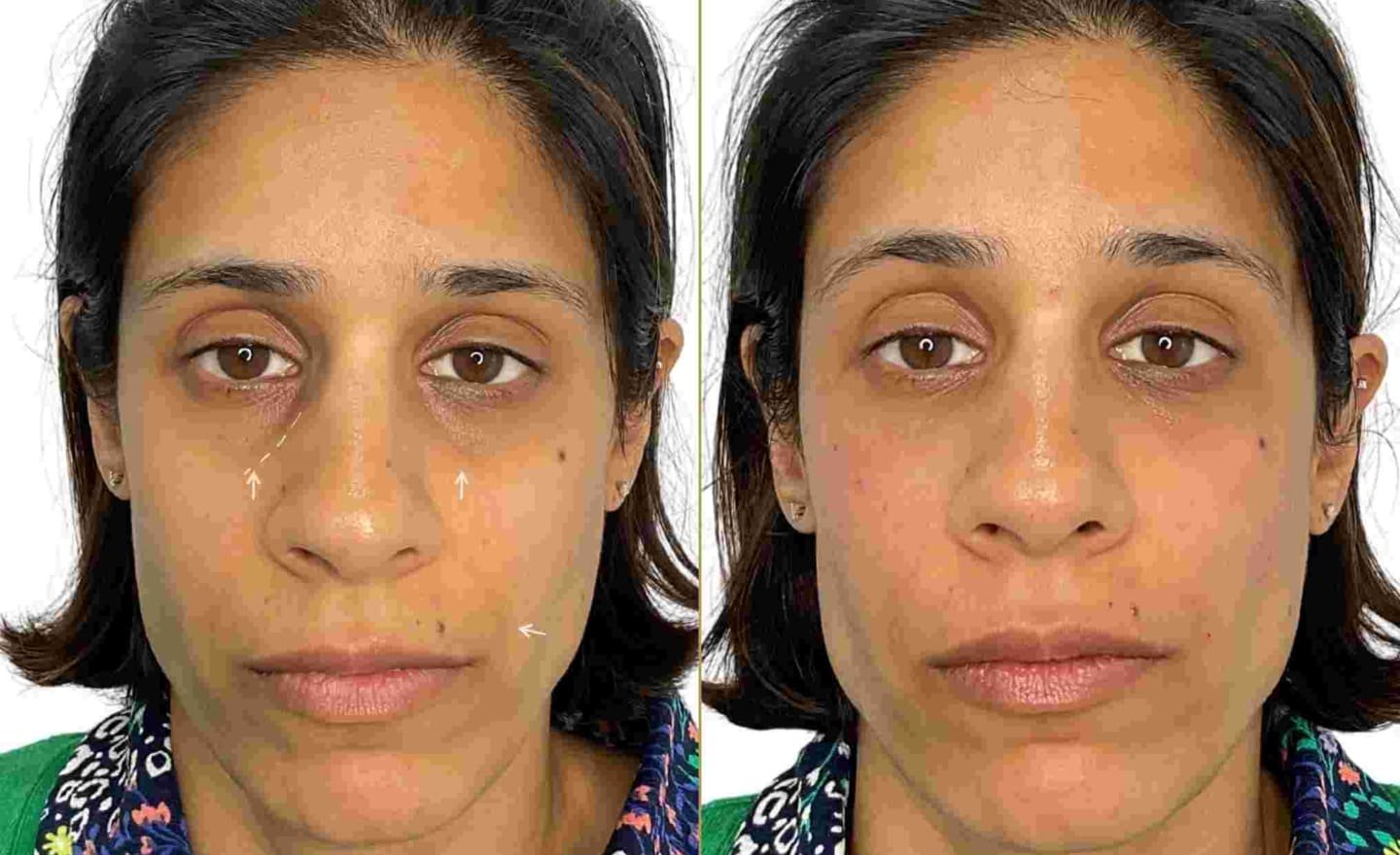 Tear Trough Filler on Female Patient for Dark Circles Before and After Results - Dr Hass Clinic London