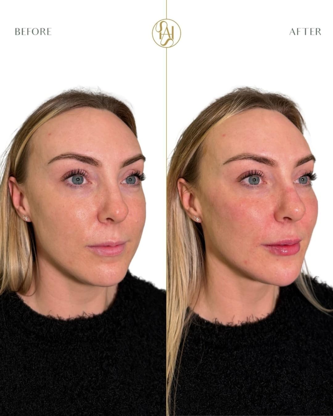 Cheek Filler Before and After - Dr Hass Clinic