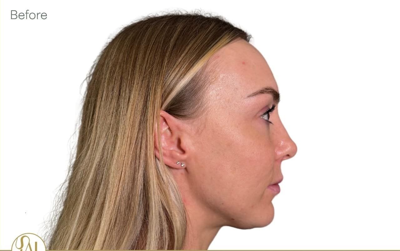 Cheek Filler Side View Before - Dr Hass Clinic