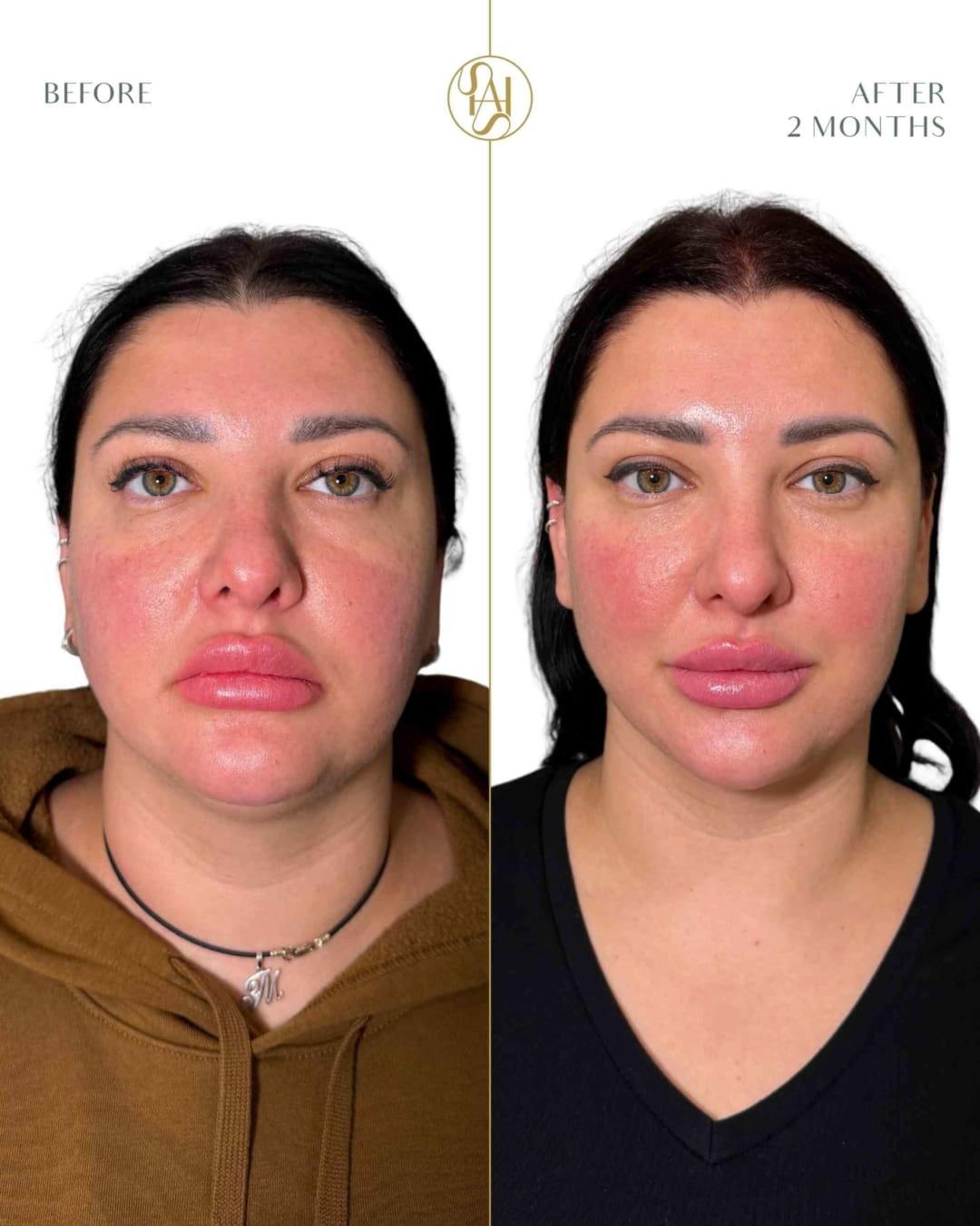 Endolift Laser Full Face Before and After at Dr Hass Clinic London
