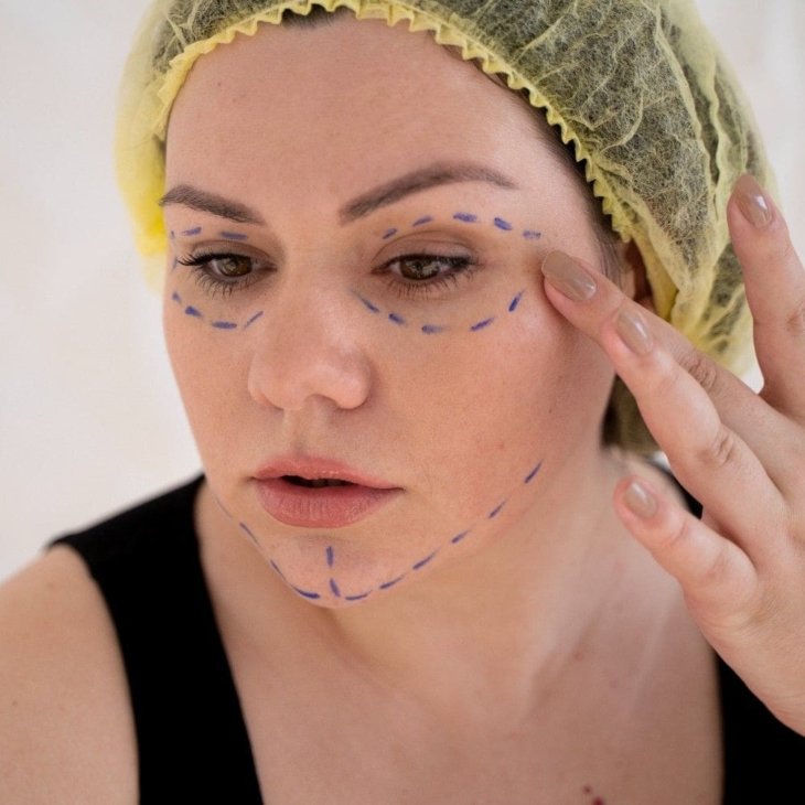Cheek Filler vs Fat Transfer: Differences Explained