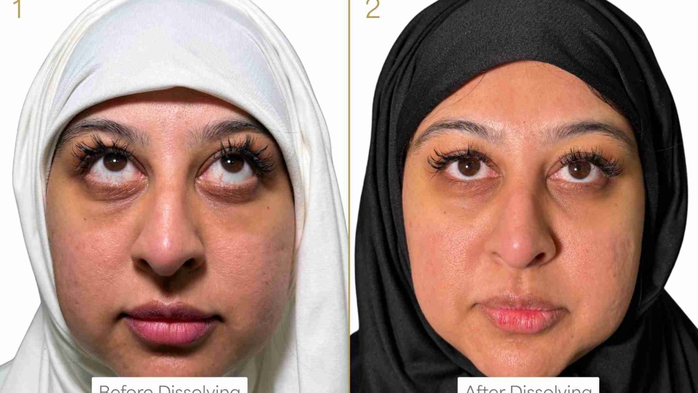 Hyaluronidase Before and After - Dr Hass Clinic